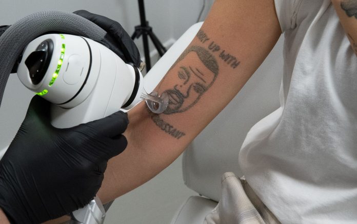 Este estudio de eliminación de tatuajes eliminará con láser tu tatuaje de Kanye West de forma gratuita